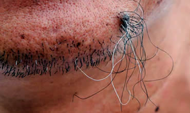 Hairs in moles