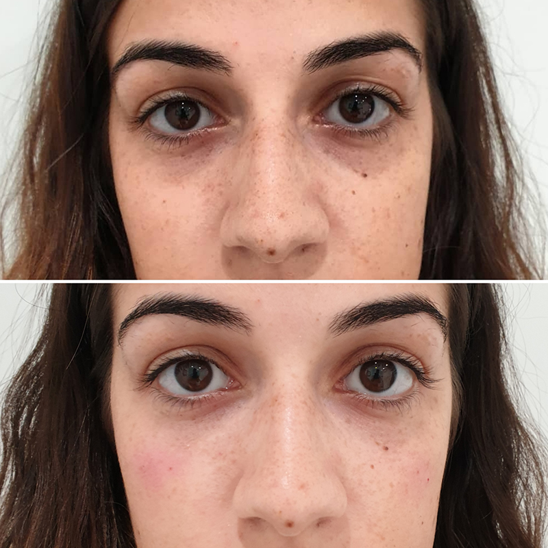 Tear Trough Filler Treatment Before and After