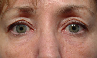 Upper and lower eyelids
